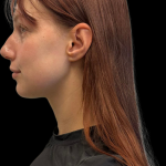 Rhinoplasty Before & After Patient #11378