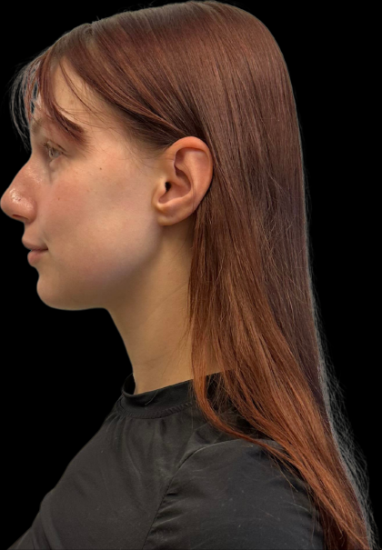 Rhinoplasty Before & After Patient #11378