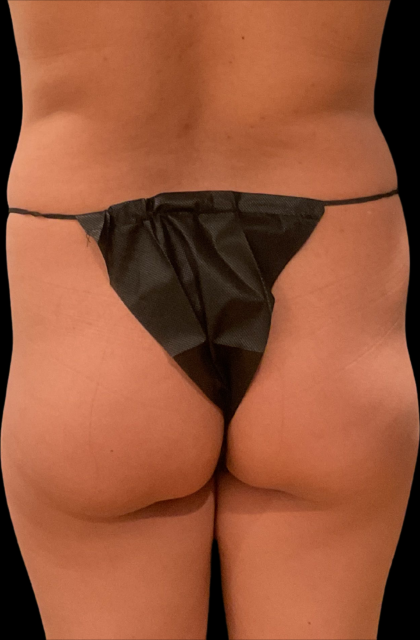 Brazilian Butt Lift Before & After Patient #11375