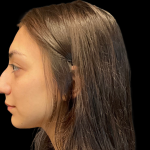Rhinoplasty Before & After Patient #11380