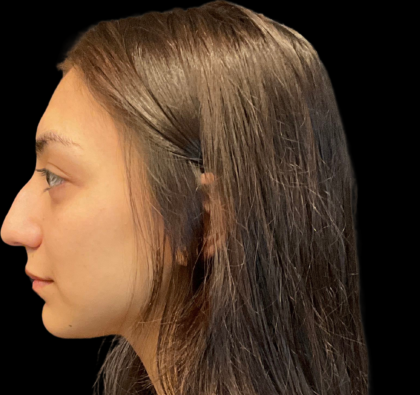 Rhinoplasty Before & After Patient #11380