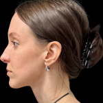 Rhinoplasty Before & After Patient #11379