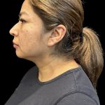 MyEllevate Before & After Patient #11374