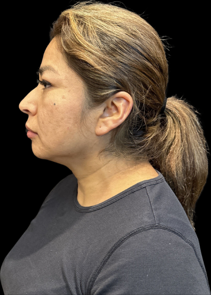 MyEllevate Before & After Patient #11374