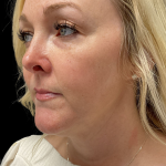AVAVA Laser Before & After Patient #11381