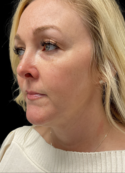 AVAVA Laser Before & After Patient #11381