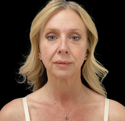 Blepharoplasty Before & After Patient #11377