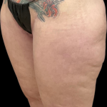 Thigh Lift Before & After Patient #11382