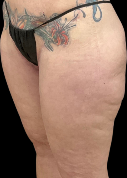 Thigh Lift Before & After Patient #11382