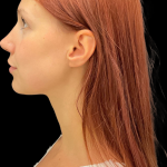 Rhinoplasty Before & After Patient #11378