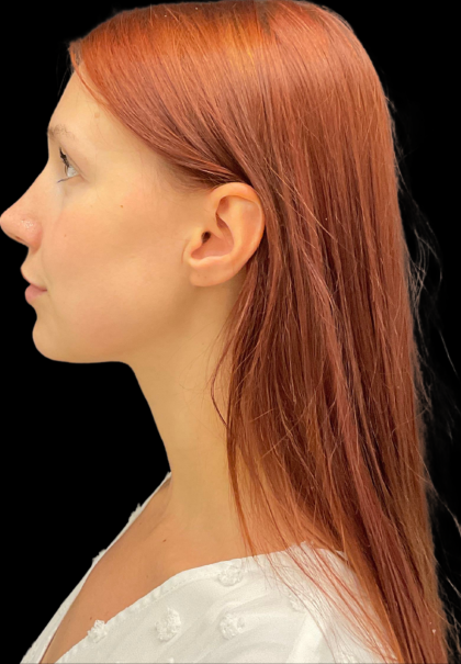 Rhinoplasty Before & After Patient #11378