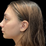 Rhinoplasty Before & After Patient #11380