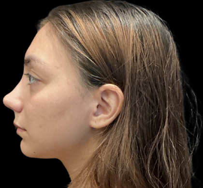 Rhinoplasty Before & After Patient #11380