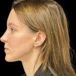 Rhinoplasty Before & After Patient #11379