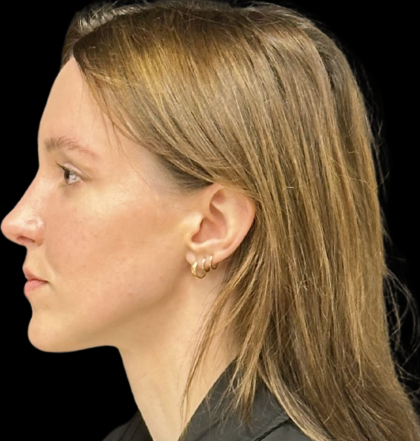 Rhinoplasty Before & After Patient #11379