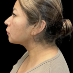 MyEllevate Before & After Patient #11374