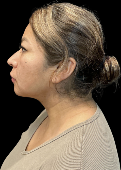 MyEllevate Before & After Patient #11374