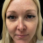 AVAVA Laser Before & After Patient #11381