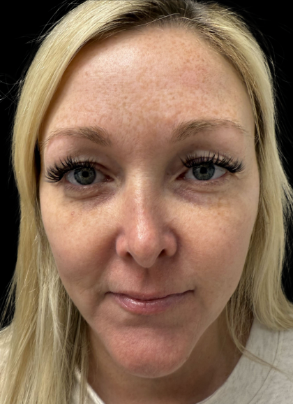 AVAVA Laser Before & After Patient #11381