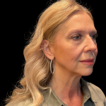 Blepharoplasty Before & After Patient #11377