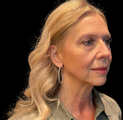 Blepharoplasty Before & After Patient #11377