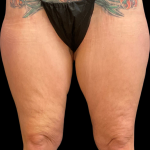 Thigh Lift Before & After Patient #11382