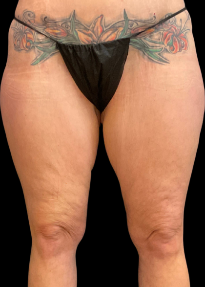 Thigh Lift Before & After Patient #11382