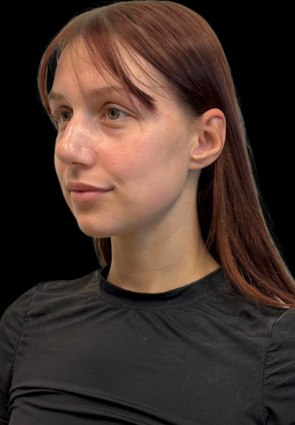 Rhinoplasty Before & After Patient #11378