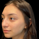 Rhinoplasty Before & After Patient #11380