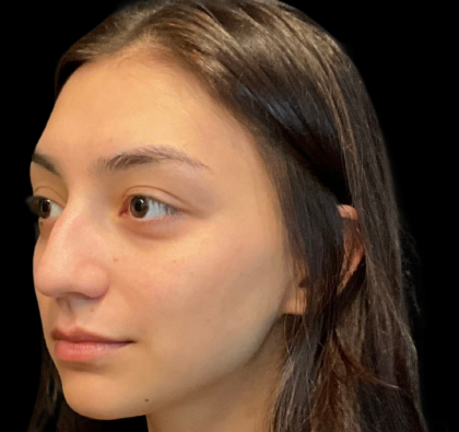 Rhinoplasty Before & After Patient #11380