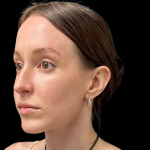 Rhinoplasty Before & After Patient #11379