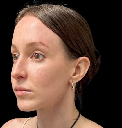 Rhinoplasty Before & After Patient #11379