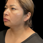 MyEllevate Before & After Patient #11374