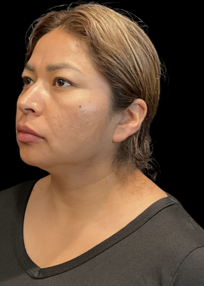 MyEllevate Before & After Patient #11374