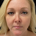 AVAVA Laser Before & After Patient #11381
