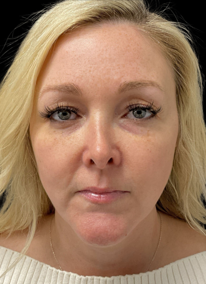 AVAVA Laser Before & After Patient #11381