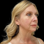 Blepharoplasty Before & After Patient #11377