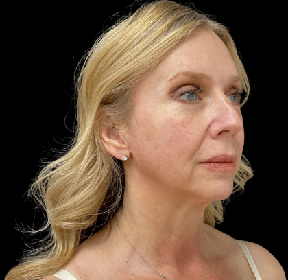 Blepharoplasty Before & After Patient #11377