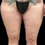 Thigh Lift Before & After Patient #11382