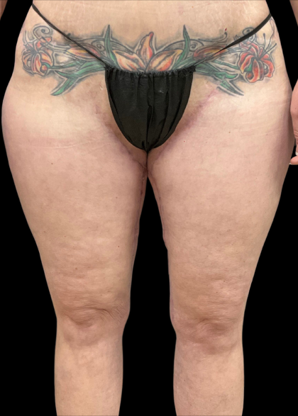 Thigh Lift Before & After Patient #11382