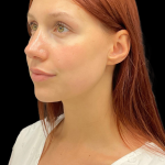 Rhinoplasty Before & After Patient #11378