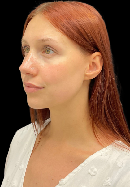 Rhinoplasty Before & After Patient #11378