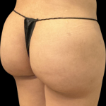 Brazilian Butt Lift Before & After Patient #11375