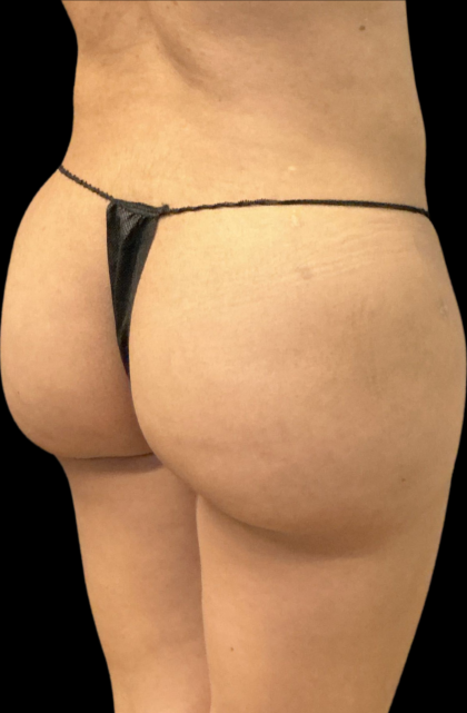 Brazilian Butt Lift Before & After Patient #11375