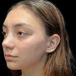 Rhinoplasty Before & After Patient #11380