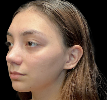 Rhinoplasty Before & After Patient #11380