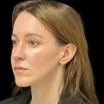 Rhinoplasty Before & After Patient #11379