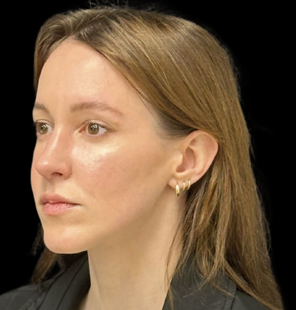 Rhinoplasty Before & After Patient #11379