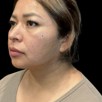 MyEllevate Before & After Patient #11374