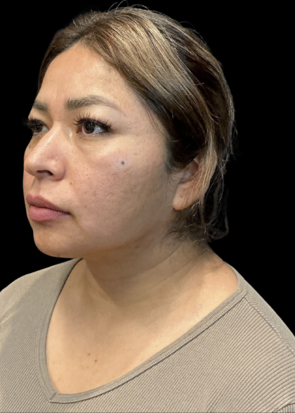 MyEllevate Before & After Patient #11374